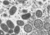 Everything You Need to Know About Monkeypox