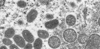 Everything You Need to Know About Monkeypox