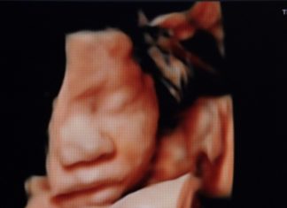 Doctors have performed brain surgery on a fetus in one of the first operations of its kind