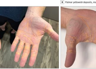 This Man Eats So Much Butter, Cheese, and Beef That Cholesterol Oozes From His Skin