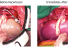Supercooled kidneys have been transplanted into pigs in a “landmark achievement”