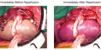 Supercooled kidneys have been transplanted into pigs in a “landmark achievement”