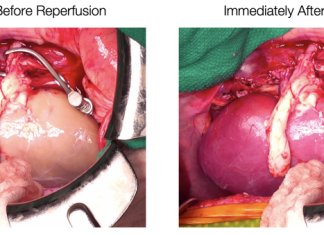 Supercooled kidneys have been transplanted into pigs in a “landmark achievement”